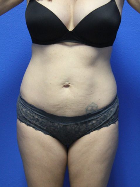 Case--8565 | Before Tummy Tuck 1