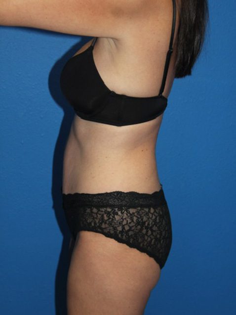 Case--8565 | After Tummy Tuck 2