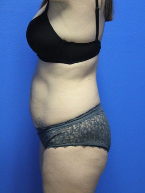 Case--8565 | Before Tummy Tuck 2