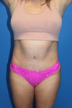 Case--9868 | After Tummy Tuck 1