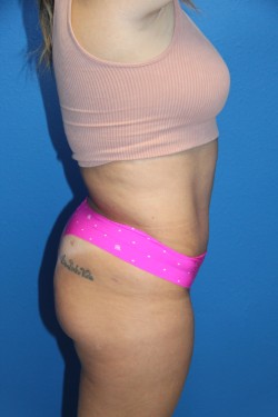 Case--9868 | After Tummy Tuck 2