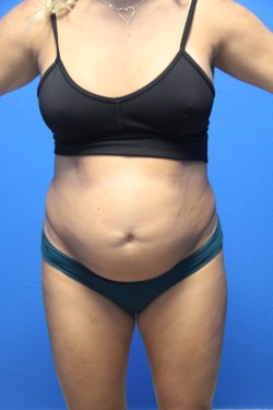 Case--9868 | Before Tummy Tuck 1