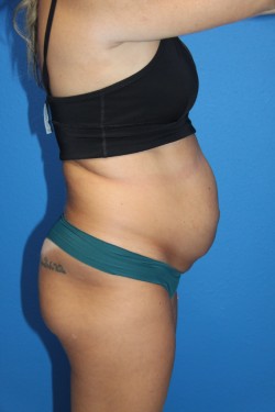 Case--9868 | Before Tummy Tuck 2