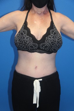 Case--2980 | After Tummy Tuck 1