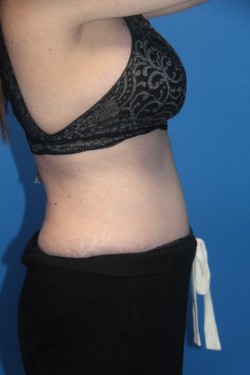 Case--2980 | After Tummy Tuck 2
