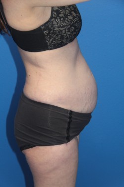 Case--2980 | Before Tummy Tuck 2