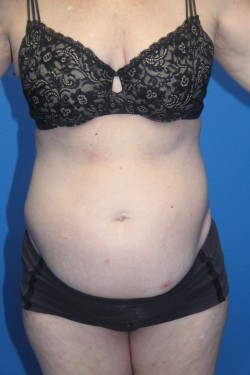 Case--2980 | Before Tummy Tuck 1