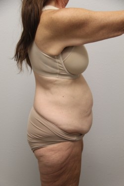 Case--8140 | Before Tummy Tuck 2