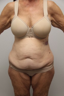 Case--8140 | Before Tummy Tuck 1