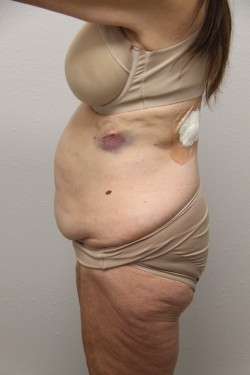 Case--8140 | Before Tummy Tuck 3