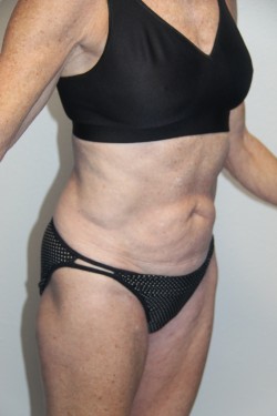 Case--2183 | After Tummy Tuck 2