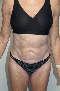 Case--2183 | After Tummy Tuck 1