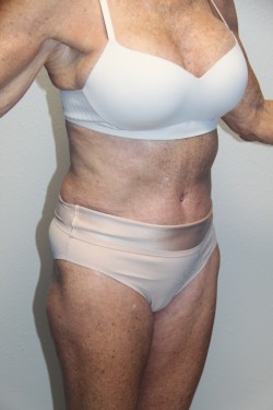 Case--2183 | Before Tummy Tuck 2