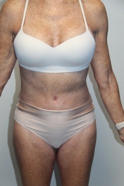Case--2183 | Before Tummy Tuck 1