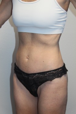 Case--3155 | After Tummy Tuck 2