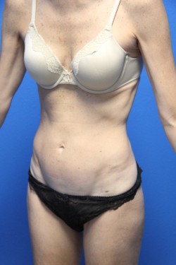 Case--3155 | Before Tummy Tuck 2