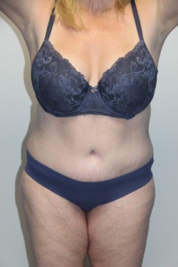 Case--2254 | After Tummy Tuck 1