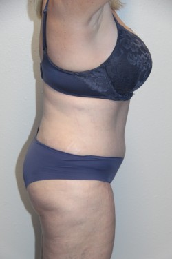 Case--2254 | After Tummy Tuck 2