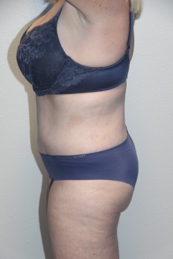 Case--2254 | After Tummy Tuck 3