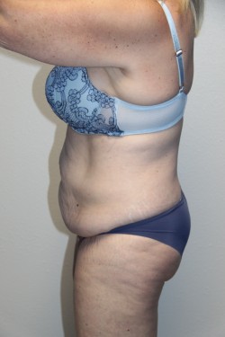 Case--2254 | Before Tummy Tuck 3