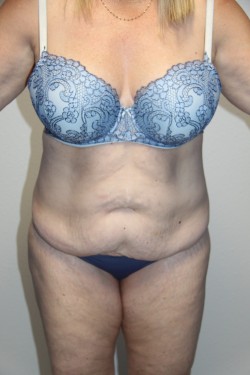Case--2254 | Before Tummy Tuck 1