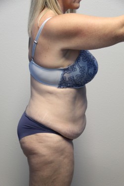 Case--2254 | Before Tummy Tuck 2