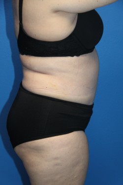 Case--6336 | After Tummy Tuck 3
