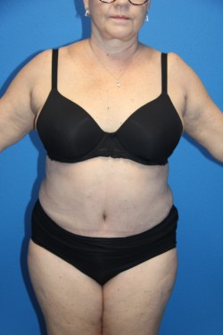 Case--6336 | After Tummy Tuck 1