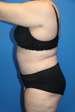 Case--6336 | After Tummy Tuck 2