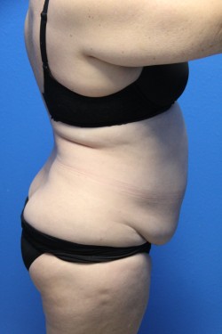 Case--6336 | Before Tummy Tuck 3