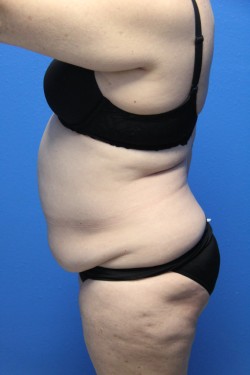 Case--6336 | Before Tummy Tuck 2