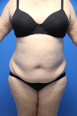 Case--6336 | Before Tummy Tuck 1