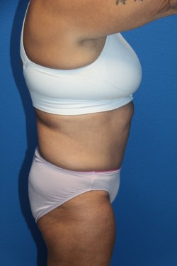 Case--1946 | After Tummy Tuck 1