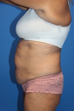 Case--1946 | Before Tummy Tuck 2