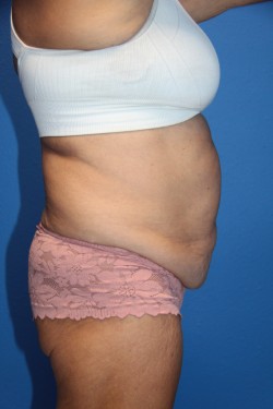 Case--1946 | Before Tummy Tuck 1