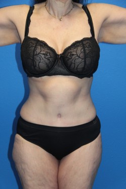 Case--8151 | After Tummy Tuck 1