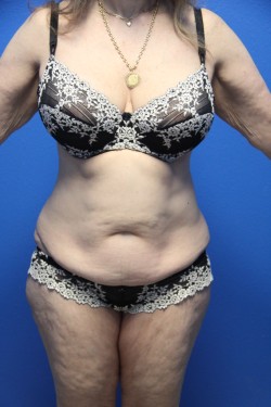 Case--8151 | Before Tummy Tuck 1