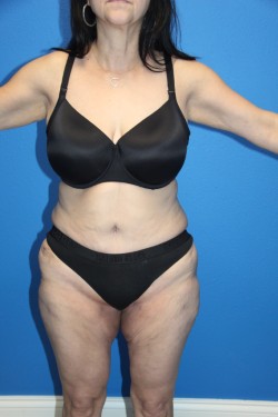 Case--6045 | After Tummy Tuck 1