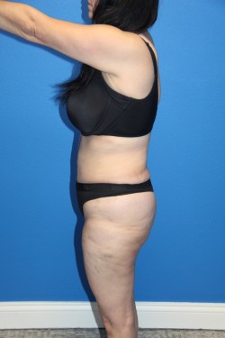 Case--6045 | After Tummy Tuck 2