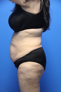 Case--6045 | Before Tummy Tuck 2