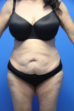 Case--6045 | Before Tummy Tuck 1