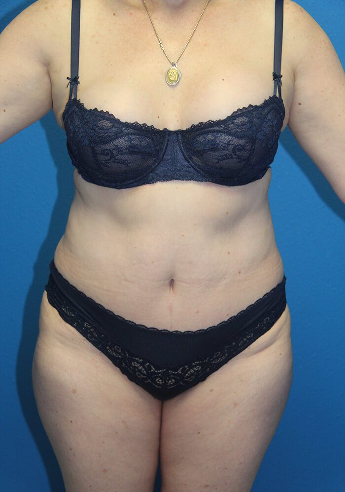 Case--7894 | After Tummy Tuck 1