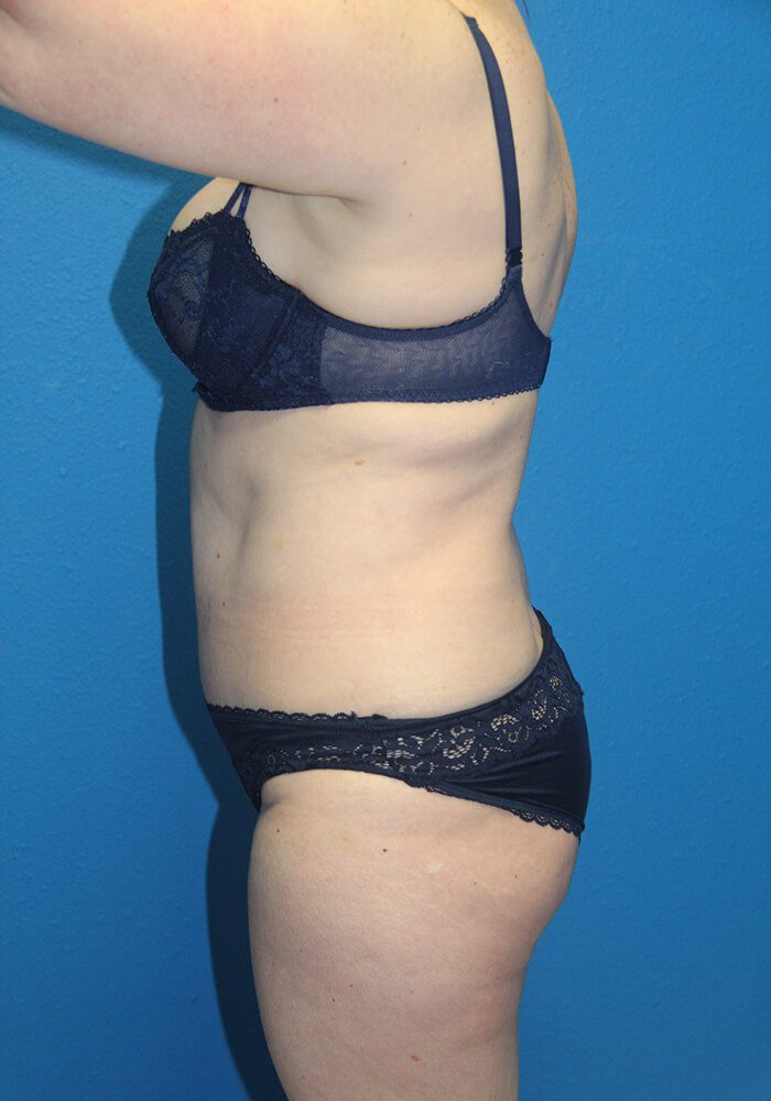 Case--7894 | After Tummy Tuck 2