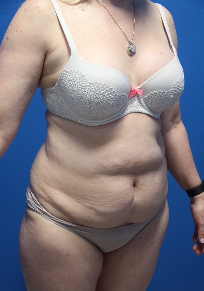 Case--7894 | Before Tummy Tuck 3