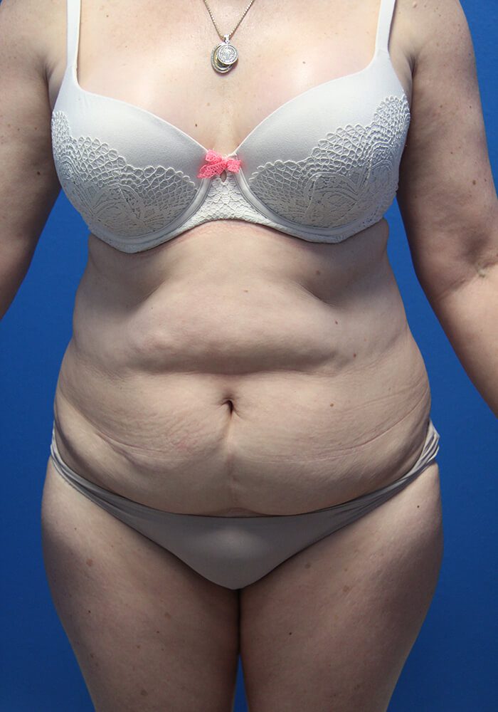 Case--7894 | Before Tummy Tuck 1