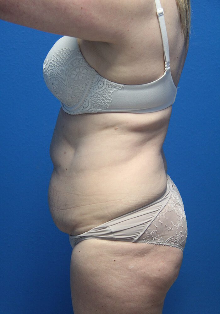 Case--7894 | Before Tummy Tuck 2