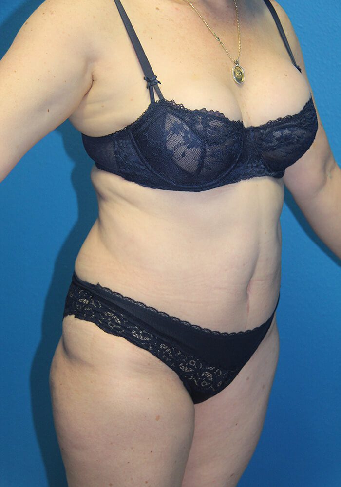Case--7894 | After Tummy Tuck 3